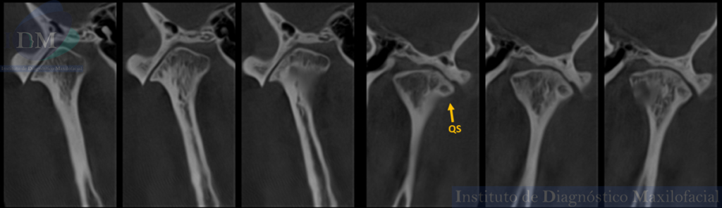 Caso 269 - Trastorno degenerativo de ATM (Osteoartritis) IDM cortes coronales