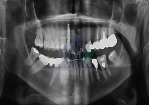 Caso 269 - Trastorno degenerativo de ATM (Osteoartritis) IDM panorámica 01