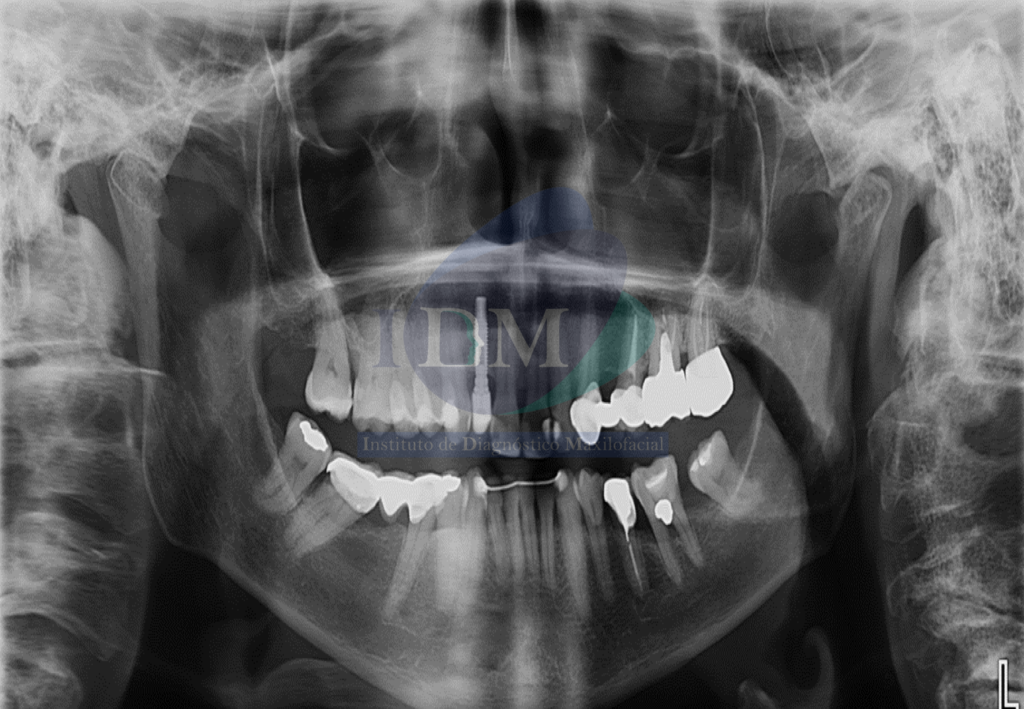 Caso 269 - Trastorno degenerativo de ATM (Osteoartritis) IDM panorámica 02