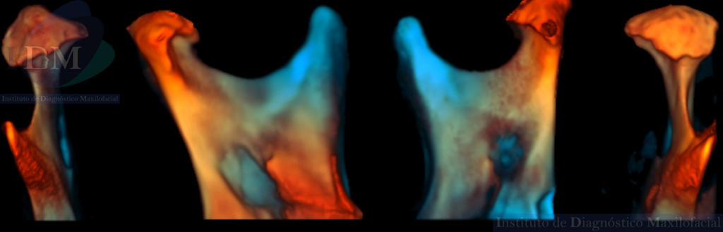 Caso 269 - Trastorno degenerativo de ATM (Osteoartritis) IDM reconstrucción 3D'