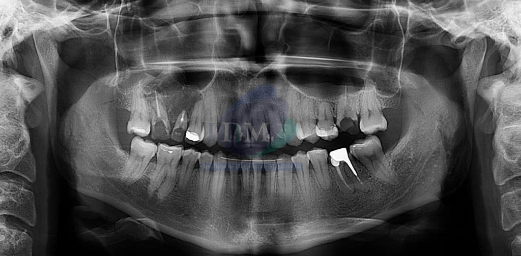 Caso 270 - MIXOMA ODONTOGÉNICO IDM PERU RADIOGRAFIA PANORAMICA 01
