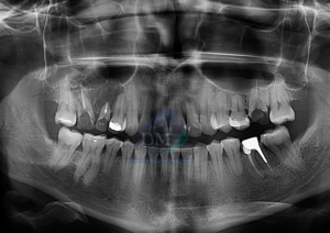 Caso 270 - MIXOMA ODONTOGÉNICO IDM PERU RADIOGRAFIA PANORAMICA 02