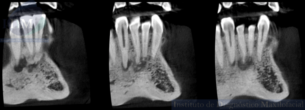 Caso 271 - DISPLASIA CEMENTO ÓSEA PERIAPICAL IDM PERU CORTES TANGENCIALES