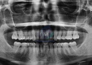 Caso 271 - DISPLASIA CEMENTO ÓSEA PERIAPICAL IDM PERU RADIOGRAFIA PANORAMICA 01