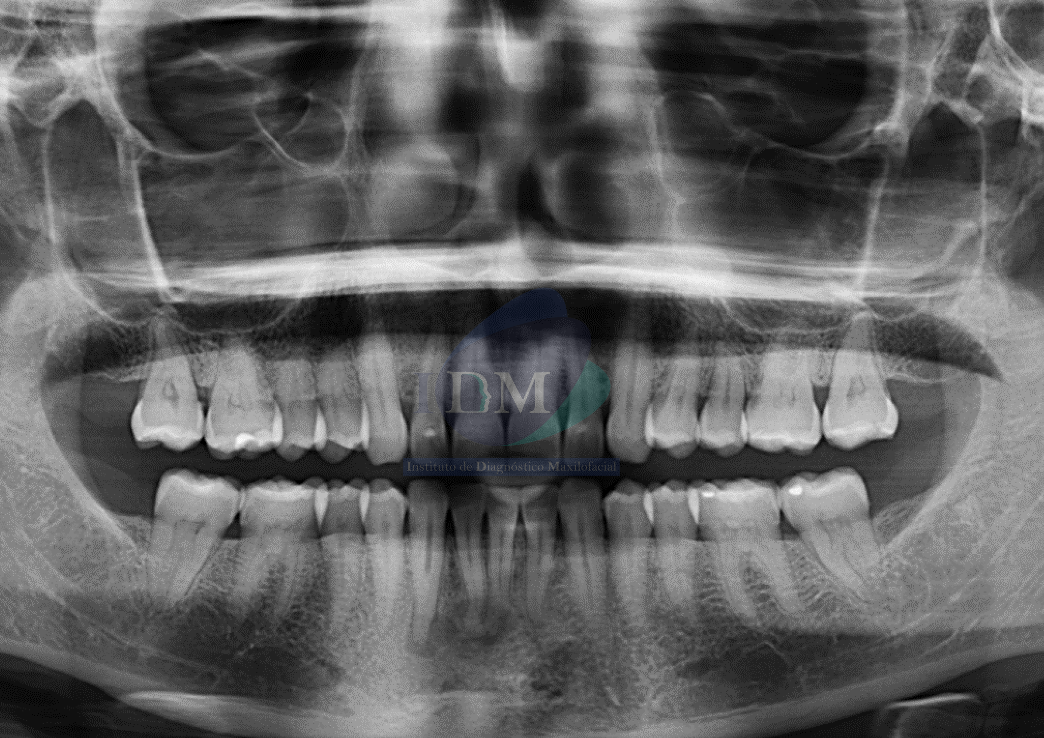 Caso 271 - DISPLASIA CEMENTO ÓSEA PERIAPICAL IDM PERU RADIOGRAFIA PANORAMICA 01