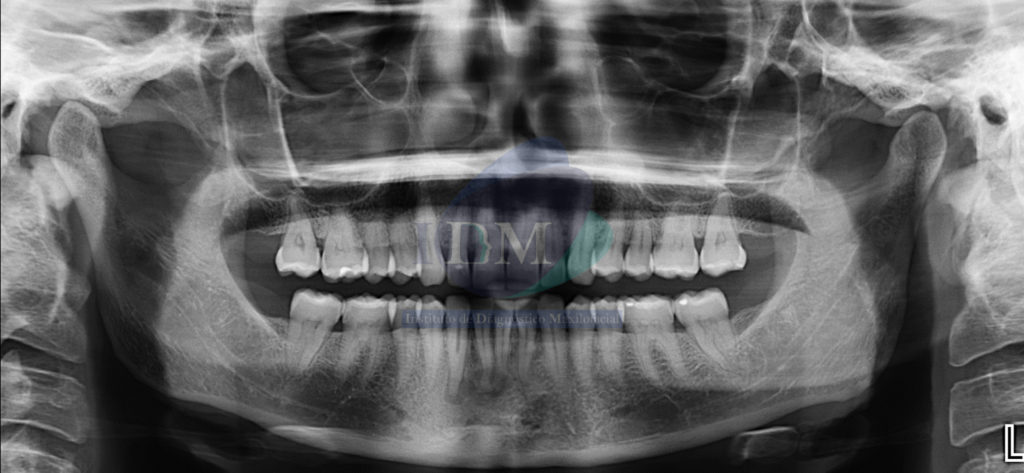 Caso 271 - DISPLASIA CEMENTO ÓSEA PERIAPICAL IDM PERU RADIOGRAFIA PANORAMICA 2