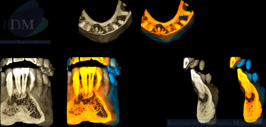 Caso 271 - DISPLASIA CEMENTO ÓSEA PERIAPICAL IDM PERU RECONSTRUCCIÓN 3D