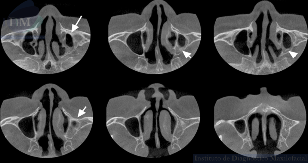 Caso 274 - IDM – HIPOPLASIA DE SENO MAXILAR UNILATERAL IDM CORTES AXIALES