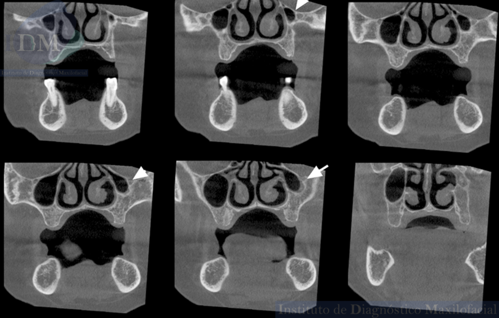 Caso 274 - IDM – HIPOPLASIA DE SENO MAXILAR UNILATERAL IDM CORTES CORONALES
