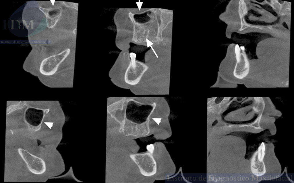 Caso 274 - IDM – HIPOPLASIA DE SENO MAXILAR UNILATERAL IDM CORTES SAGITALES