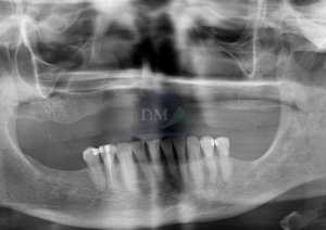 Caso 274 - IDM – HIPOPLASIA DE SENO MAXILAR UNILATERAL IDM RADIOGRAFÍA PANORÁMICA 01