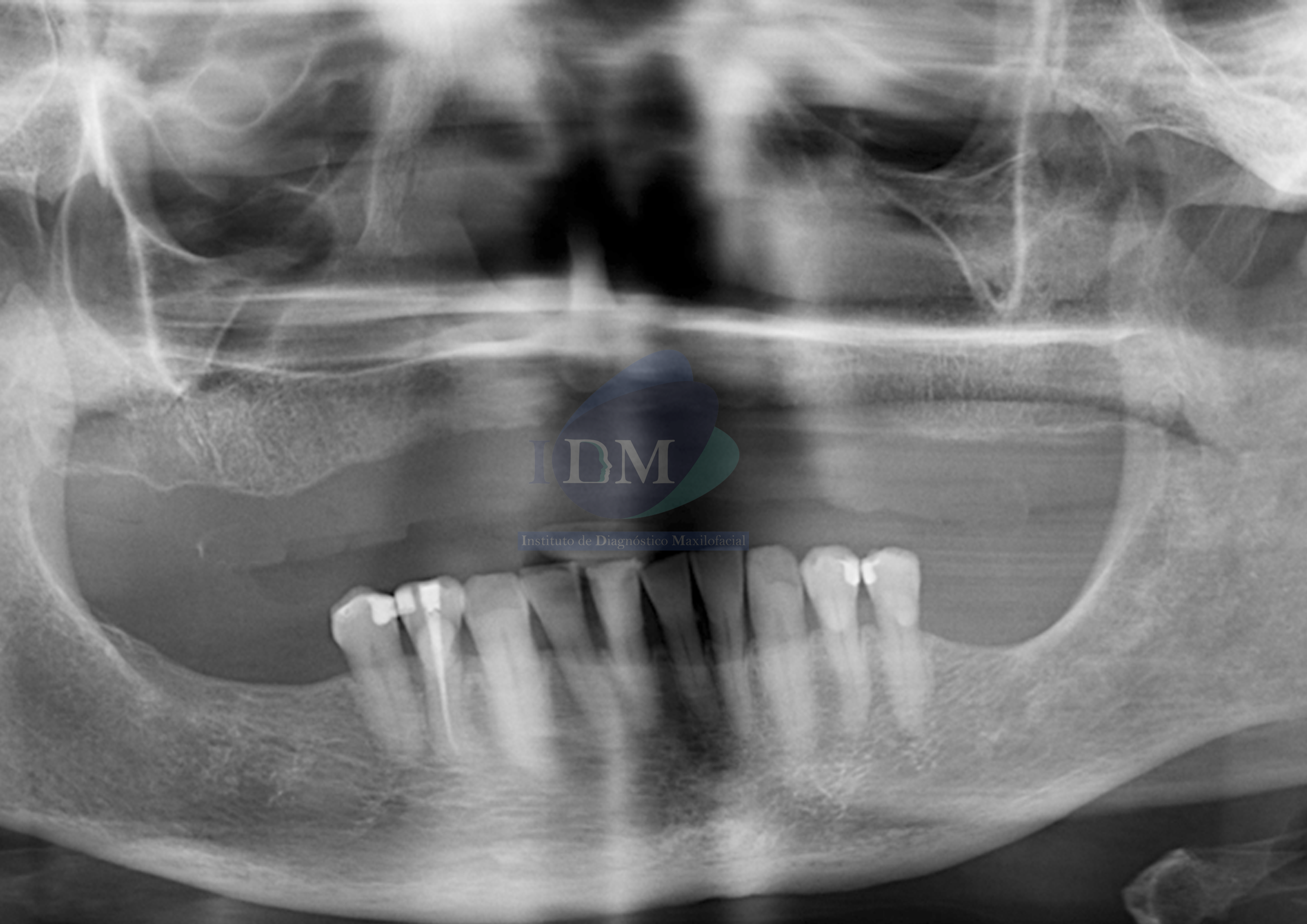 Caso 274 - IDM – HIPOPLASIA DE SENO MAXILAR UNILATERAL IDM RADIOGRAFÍA PANORÁMICA 01