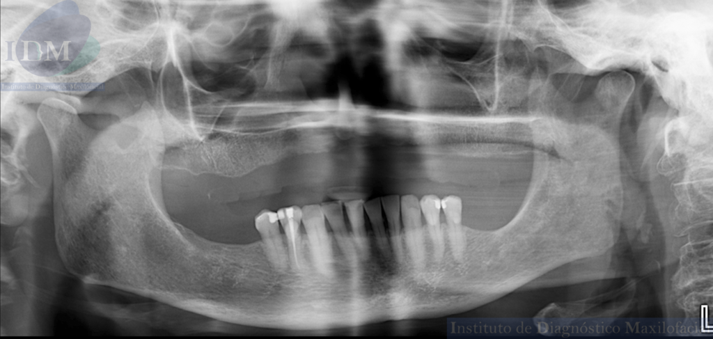 Caso 274 - IDM – HIPOPLASIA DE SENO MAXILAR UNILATERAL IDM RADIOGRAFÍA PANORÁMICA 02