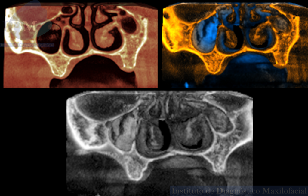Caso 274 - IDM – HIPOPLASIA DE SENO MAXILAR UNILATERAL IDM RECONSTRUCCION 3D