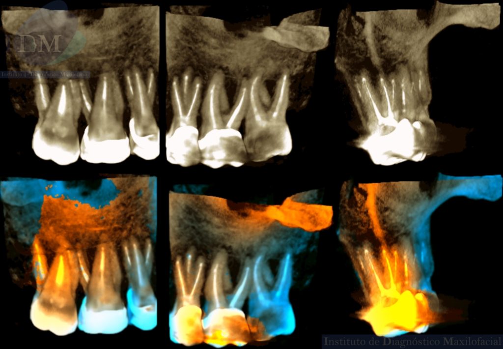 Caso 275 - IDM - PREMOLAR CON TRES SEGMENTOS RADICULARES IDM PERU RECONSTRUCCION 3D