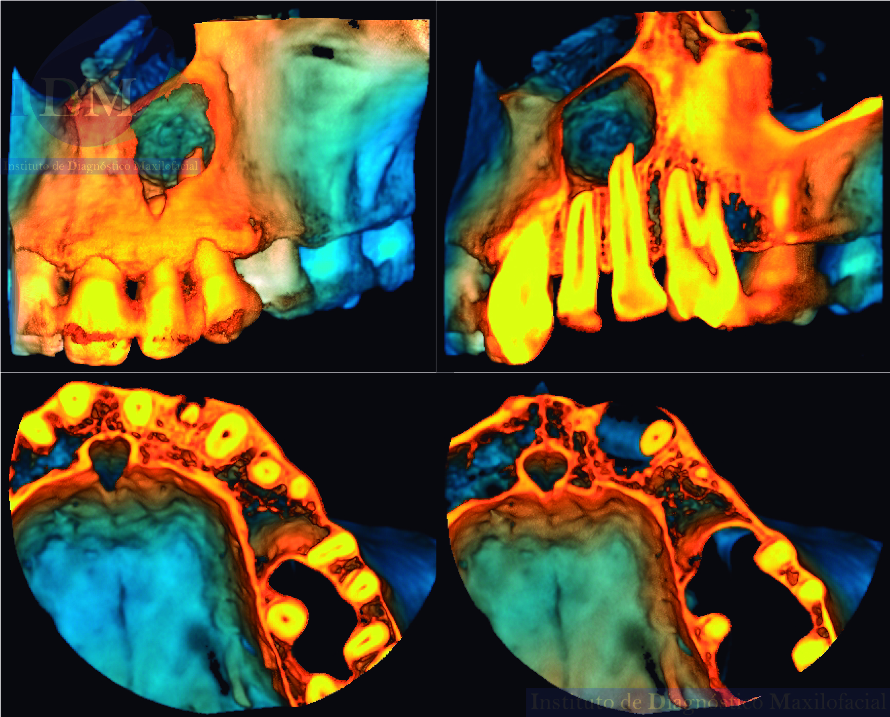 Caso 278 - IDM - QUISTE RADICULAR IDM PERU RECONSTRUCCION 3D