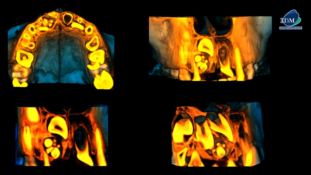 IDM CASO 272 RECONSTRUCCIONES 3D IDM