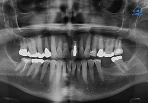 IDM CASO 273 PANORAMICA 2 IDM
