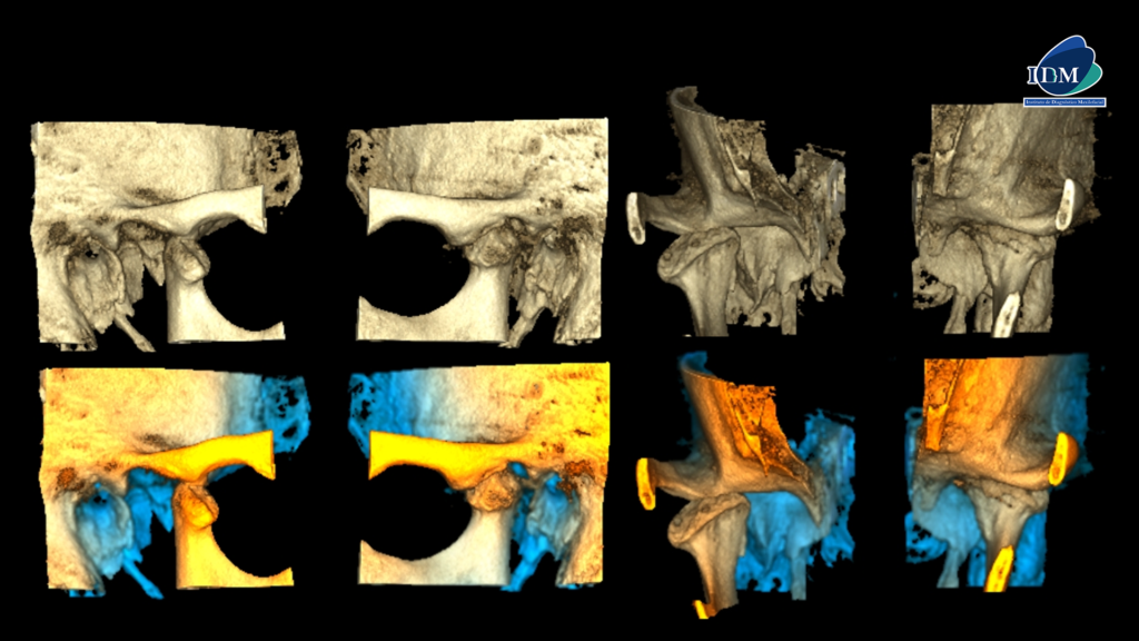 IDM CASO 273 RECONSTRUCCIONES 3D IDM