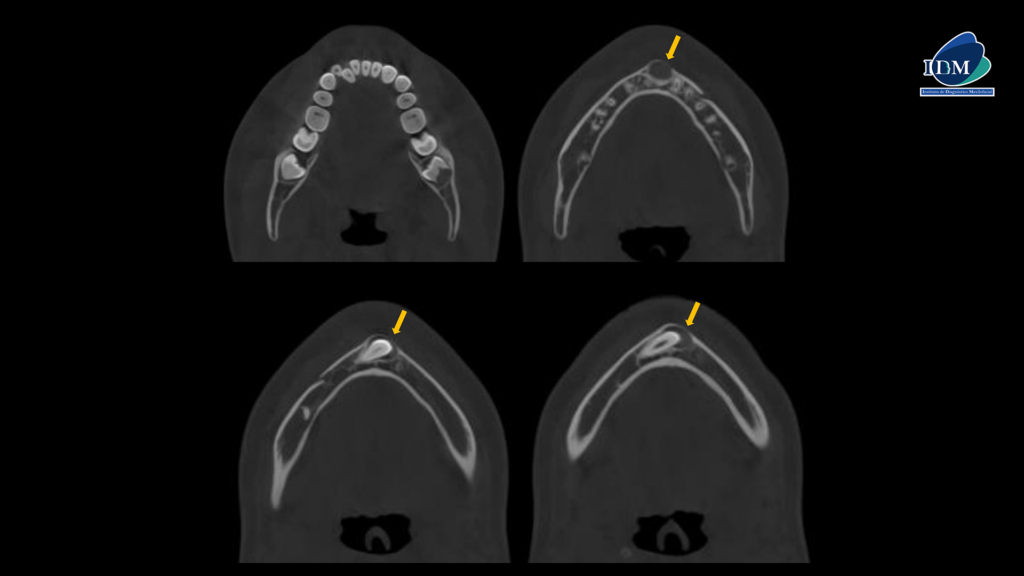 IDM-CASO-281-CORTES-AXIALES IDM