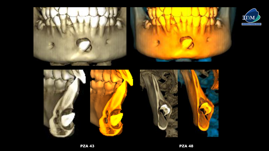 IDM-CASO-281-RECONSTRUCCIÓN-3D IDM