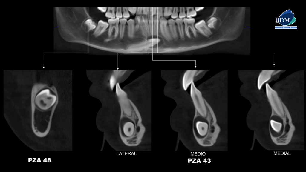 IDM-CASO-281-TRANSAXIALES IDM