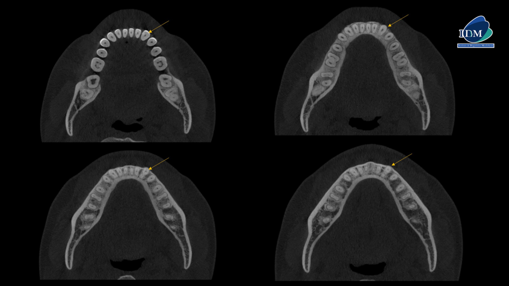 IDM CASO 284 CORTES AXIALES IDM