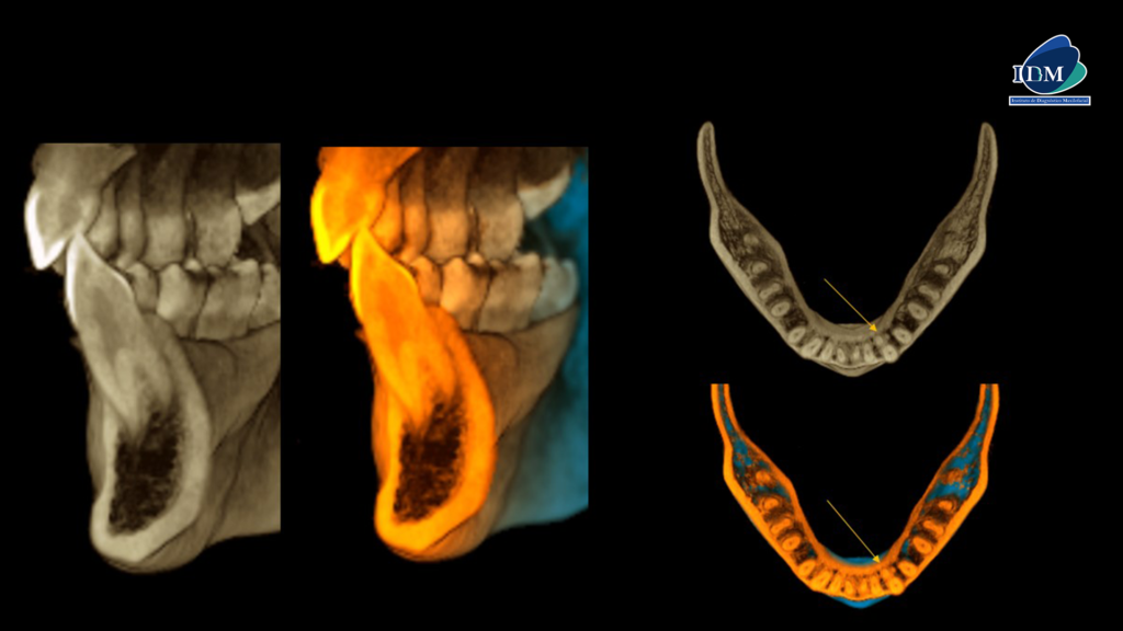 IDM CASO 284 REFORMACION 3D IDM