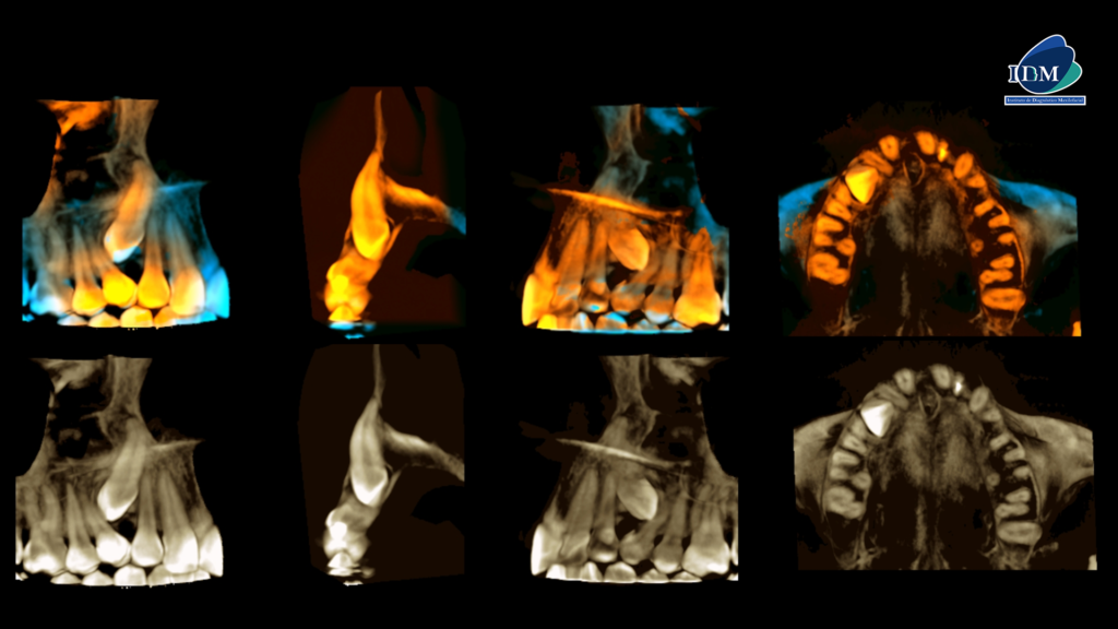 IDM CASO 285 RECONSTRUCCION 3D IDM