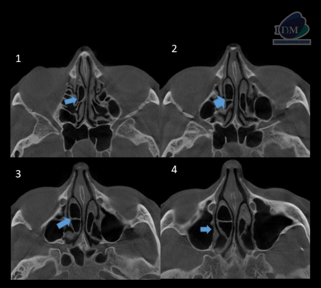 Caso 289 – IDM CORTES AXIALES IDM