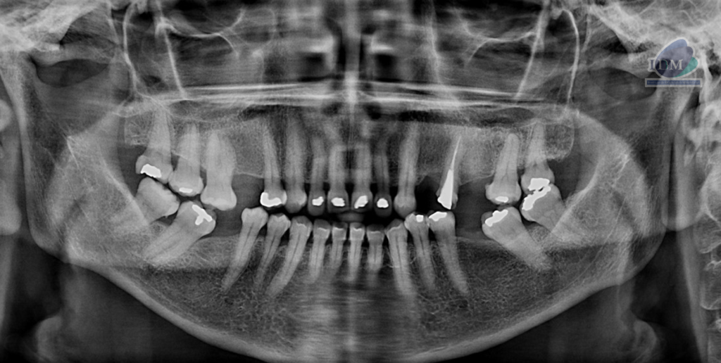 Caso 289 – IDM RADIOGRAFIA PANORAMICA IDM