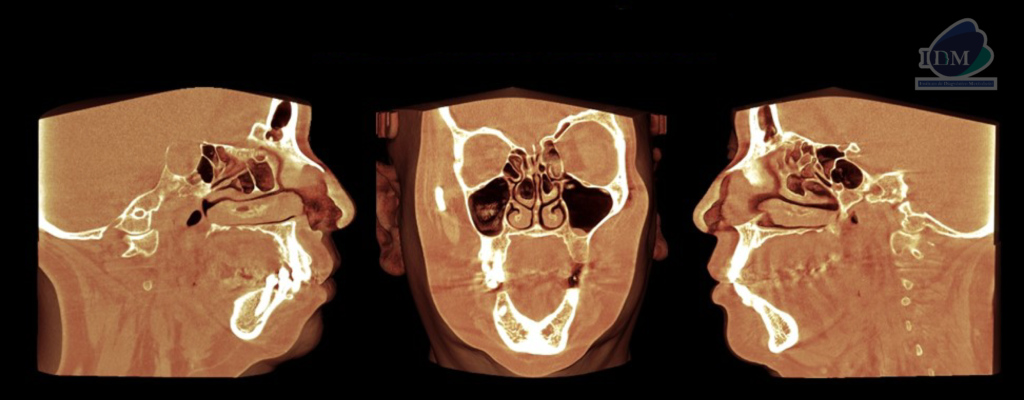 Caso 289 – IDM RECONSTRUCCION 3D IDM