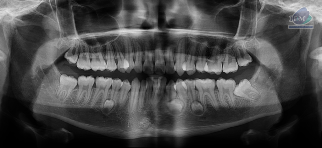Caso 290 – IDM RADIOGRAFIA PANORAMICA IDM