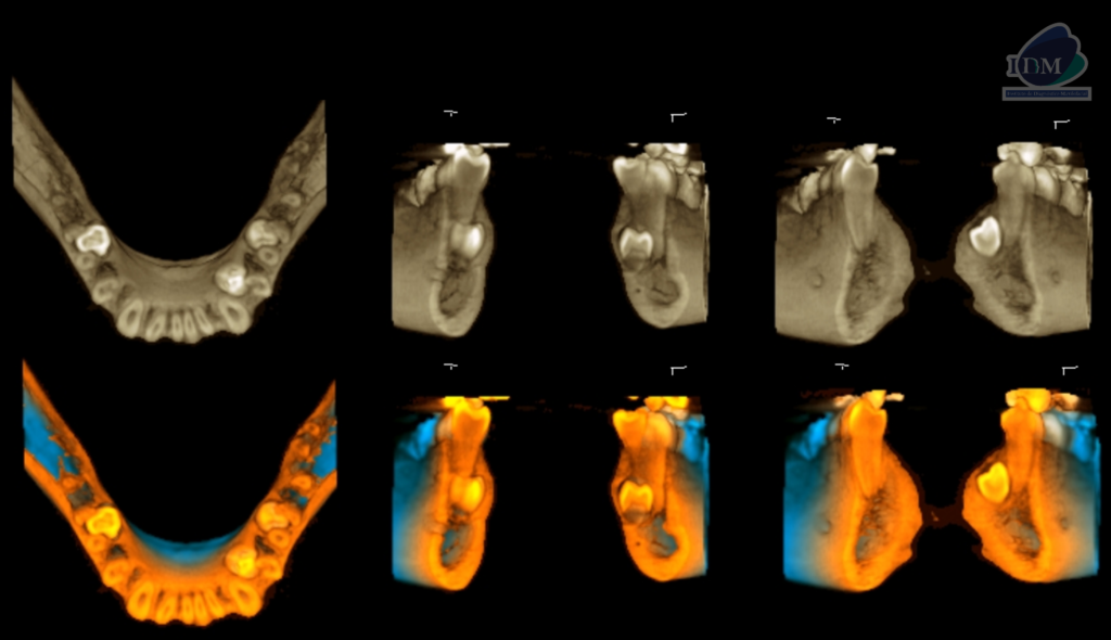 Caso 290 – IDM RECONSTRUCCION 3D - IDM