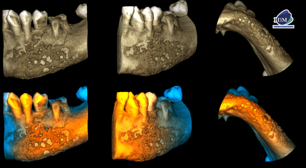 IDM CASO 287 OSTEOMIELITIS RECONSTRUCCION 3D IDM