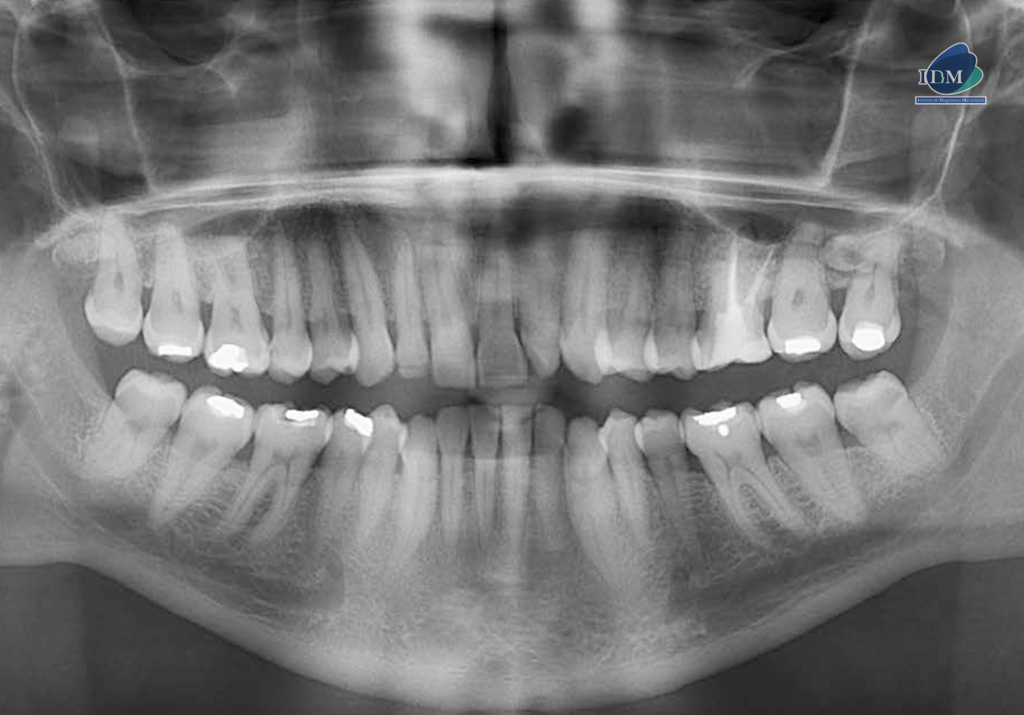 Paramolar Radiograph Caso 288 - IDM – REABSORCIÓN RADICULAR EXTERNA OCASIONADA POR UN MOLAR ...