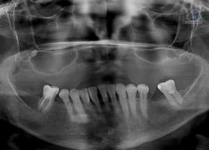 Caso 291 – IDM RADIOGRAFIA PANORAMICA 2 IDM
