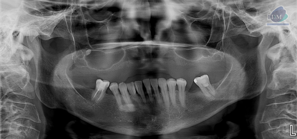 Caso 291 – IDM RADIOGRAFIA PANORAMICA IDM
