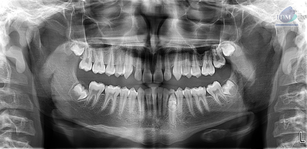Caso 292 – IDM RADIOGRAFIA PANORAMICA IDM