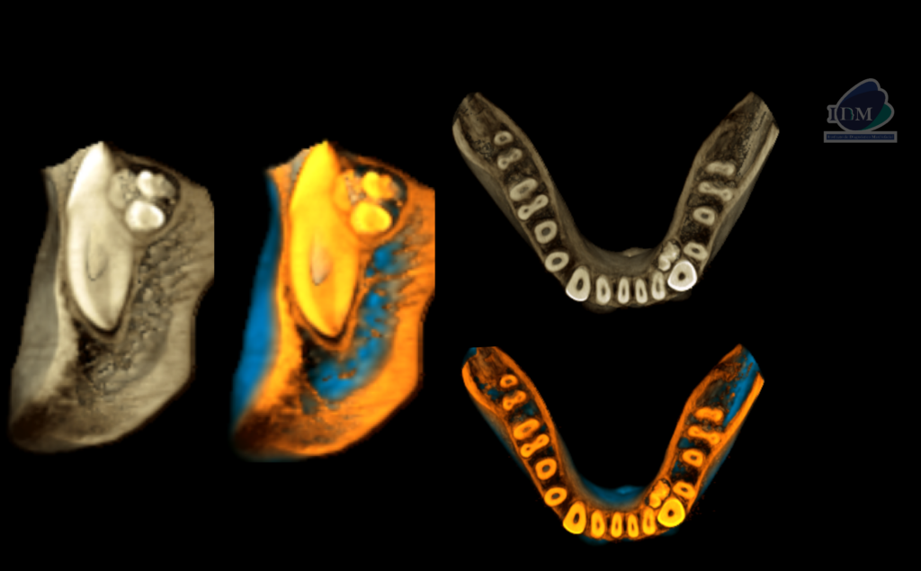 Caso 292 – IDM RECONSTRUCCION 3D - IDM