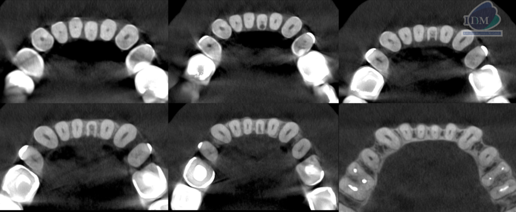 Caso 293 – IDM CORTES AXIALES IDM