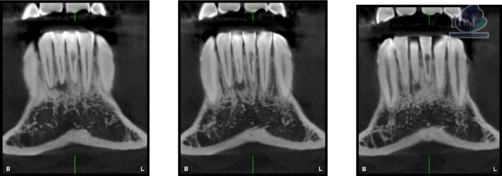 Caso 293 – IDM CORTES TANGENCIALES IDM