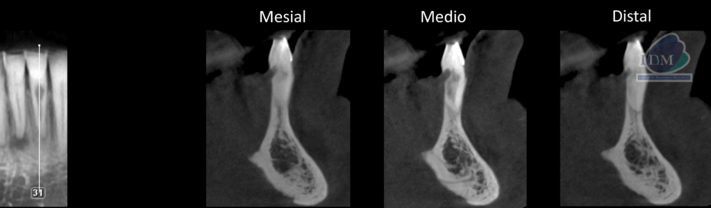 Caso 293 – IDM CORTES TRANSAXIALES IDM