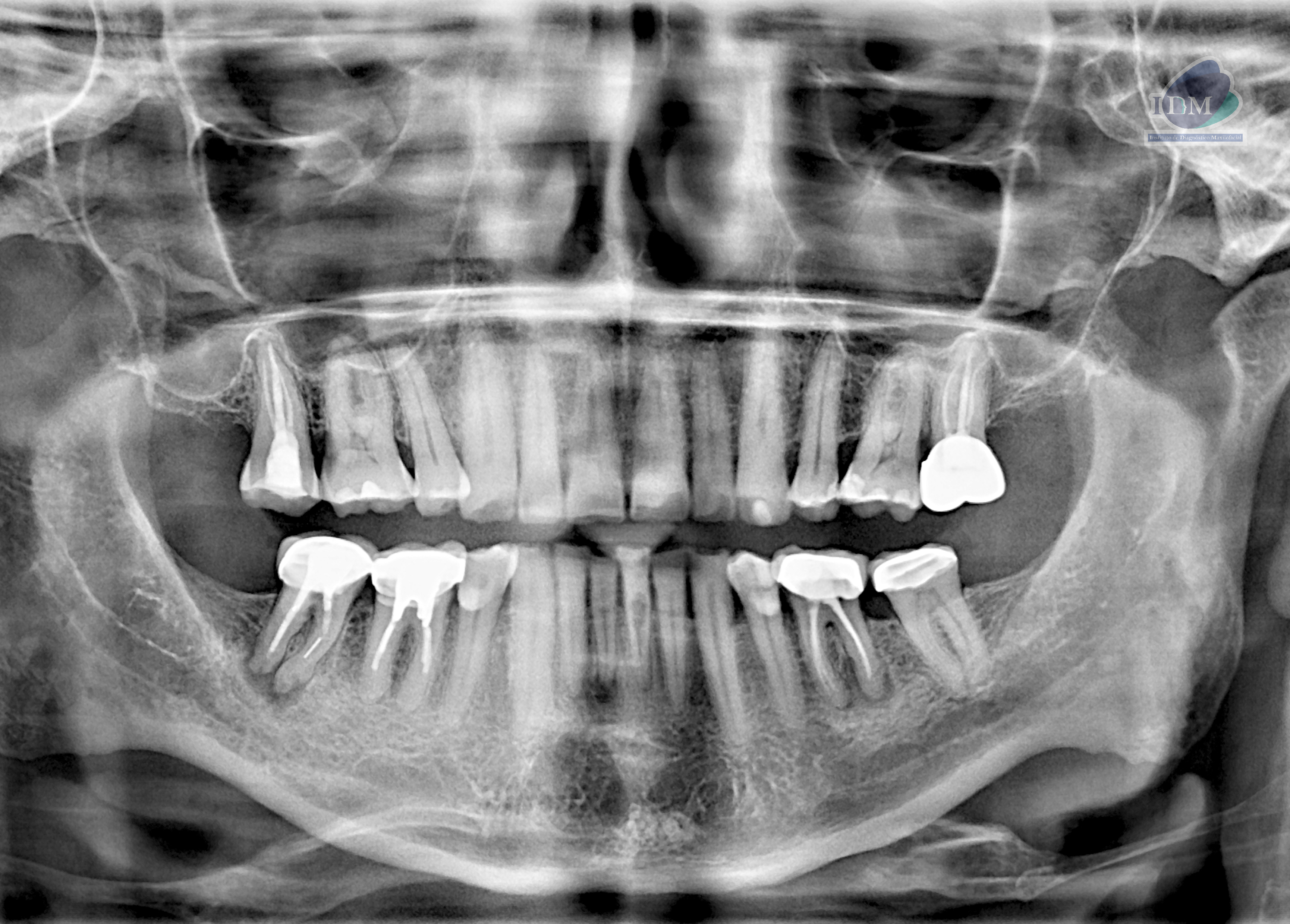 Caso 293 – IDM RADIOGRAFIA PANORAMICA 2 IDM