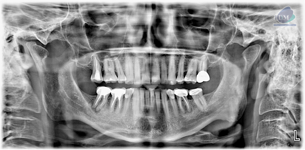 Caso 293 – IDM RADIOGRAFIA PANORAMICA IDM