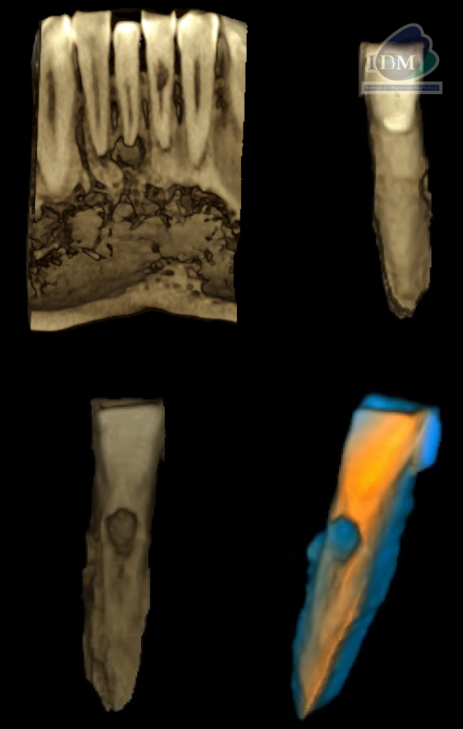 Caso 293 – IDM RECONSTRUCCION 3D - IDM