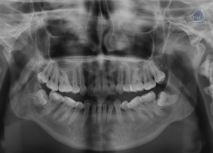 Caso 294 – IDM RADIOGRAFIA PANORAMICA 2 IDM