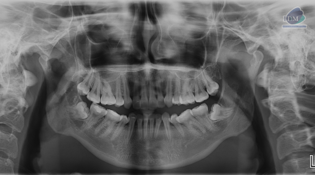 Caso 294 – IDM RADIOGRAFIA PANORAMICA IDM