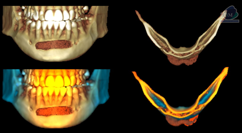 Caso 294 – IDM RECONSTRUCCION 3D - IDM