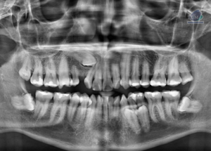 Caso 295 – IDM RADIOGRAFIA PANORAMICA IDM 2